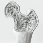 Osteoporosis stage 1 of 3 — 3d rendering